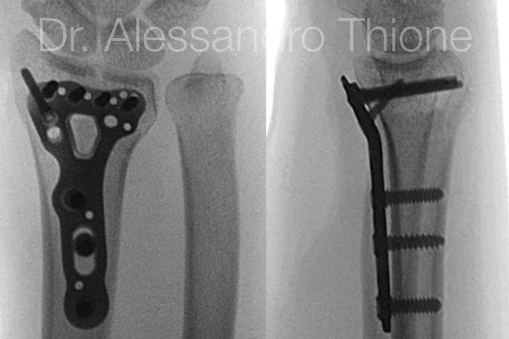 Fractura de radio distal