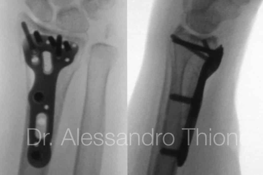 Fractura de radio distal