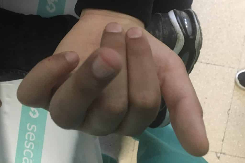 Maluninon de fractura de falange.