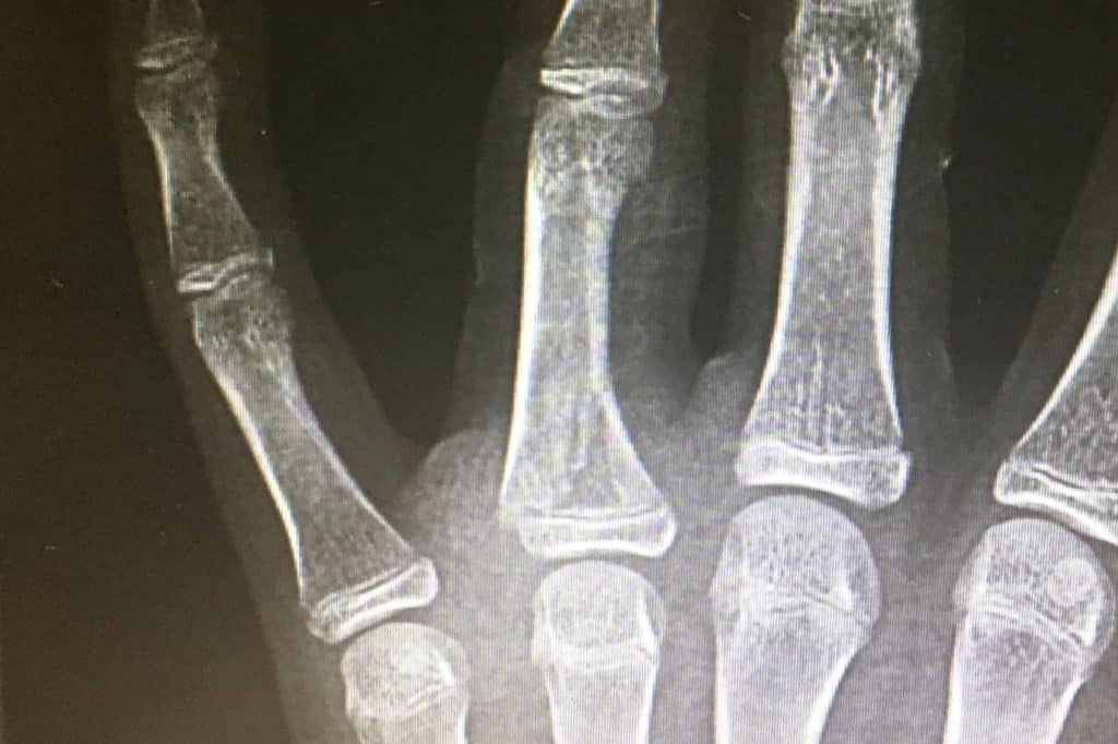Fractura d falange proximal en malrotación.