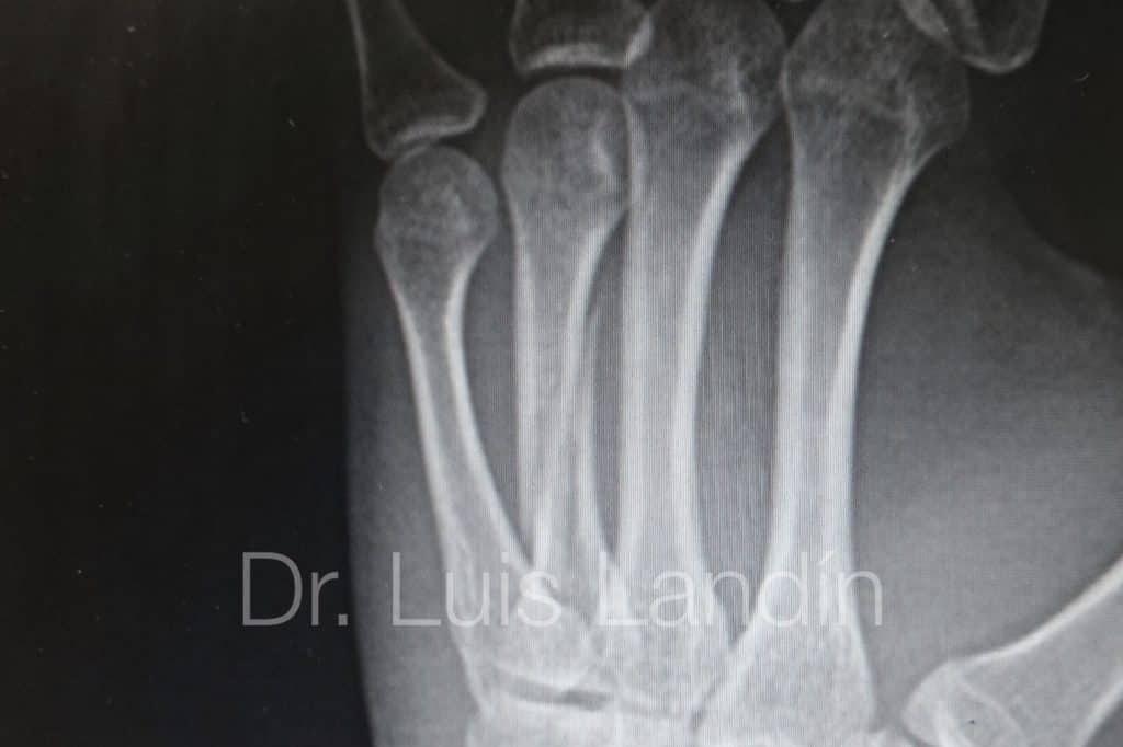 Fractura espiroidea de cuarto metacarpiano