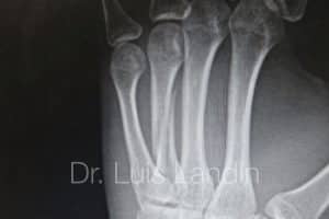 Fractura espiroidea de cuarto metacarpiano