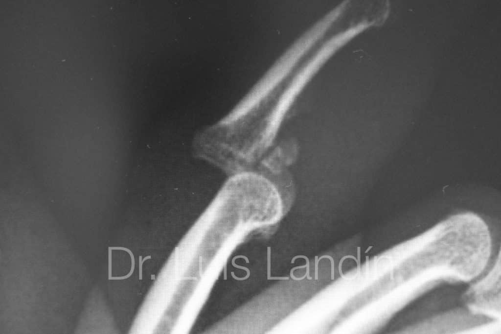 Fractura intraarticular de base de falange media