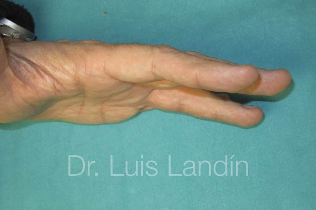 Resultados de artroplastia con placa volar
