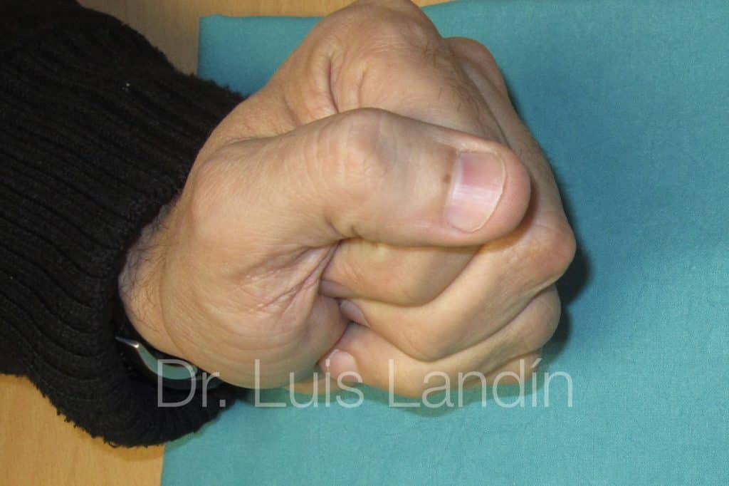 Flesión de puño con artroplastia de placa volar.