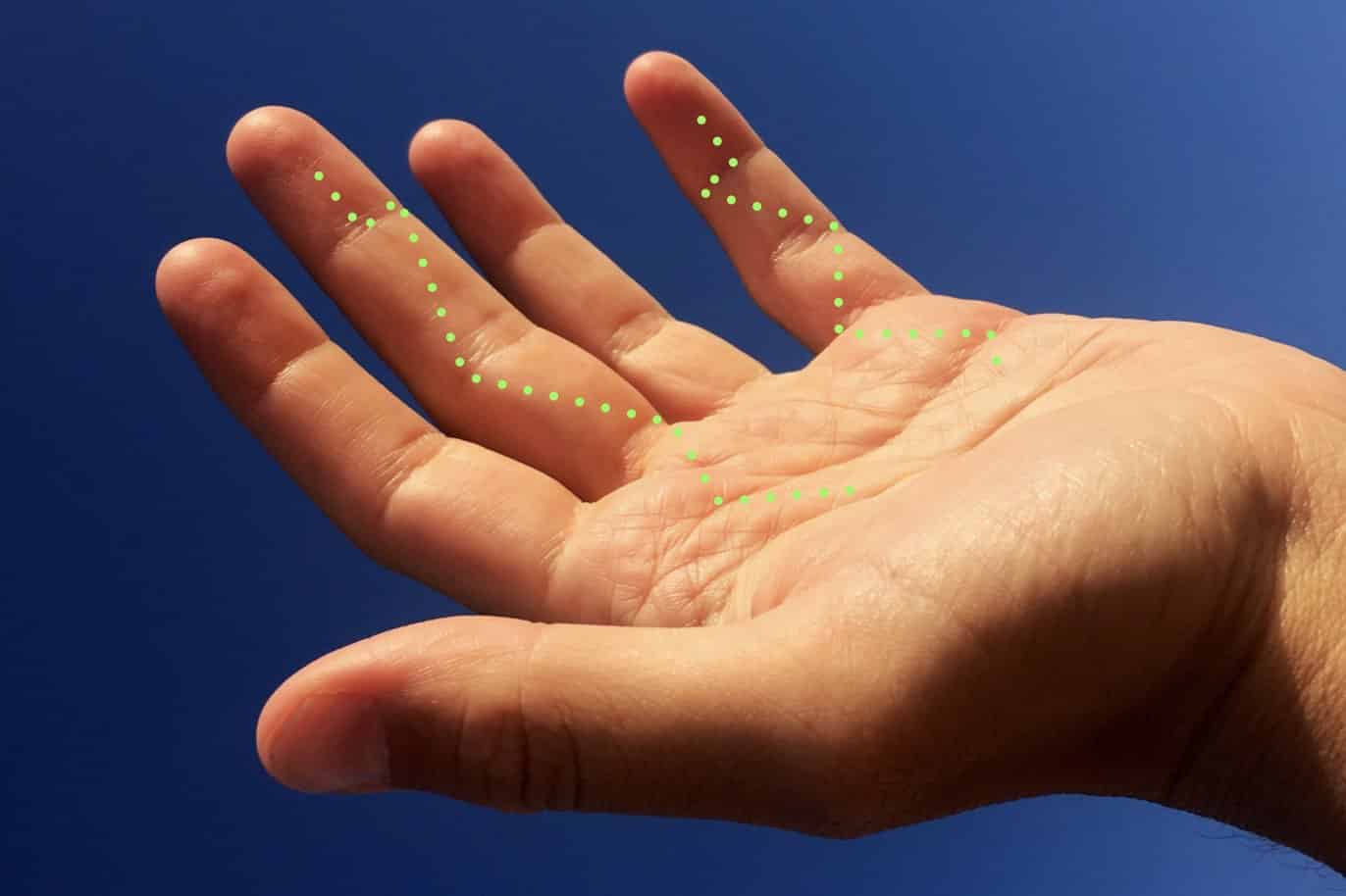 Lesiones de Tendones Flexores de la Mano - Dr. Landín - Dr. Thione