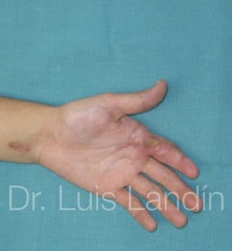 Reconstrucción de tendón flexor