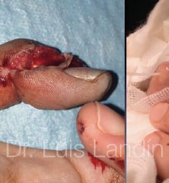 Revascularización yema dedo pulgar