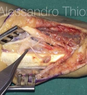 Lesion de nervio radial, rama superficial