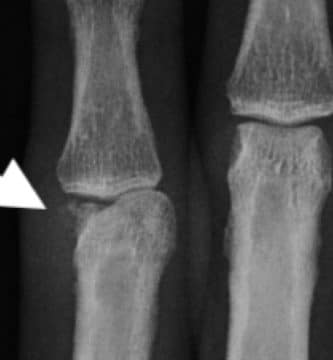 Fractura condilar de falange proximal