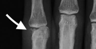 Fractura condilar de falange proximal