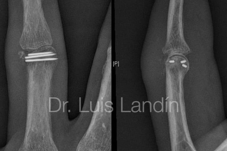 Fractura de Falange Dedo - Dr. Landín - Dr. Thione