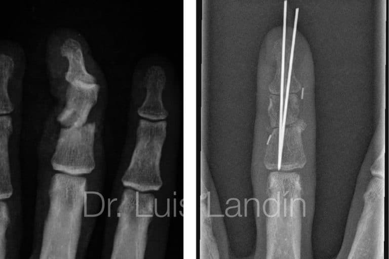 Fractura de Falange Dedo - Dr. Landín - Dr. Thione
