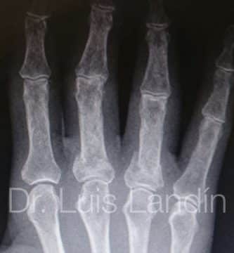 Fractura de falange proximal