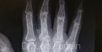 Fractura de falange proximal