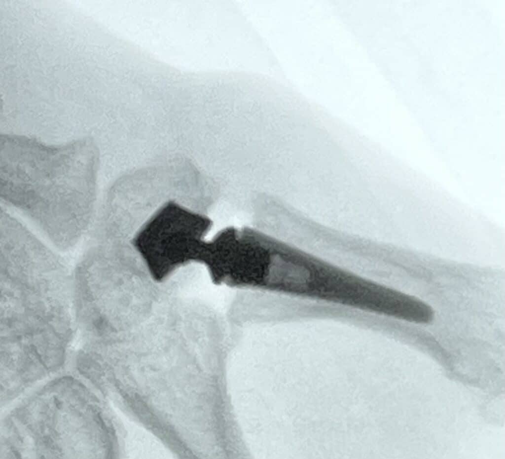 Protesis trapecio metacarpiana para el tratamineto de la rizartrosis