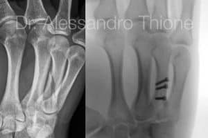 Fracturas de la mano