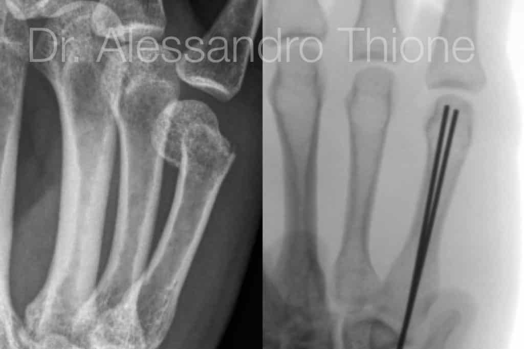 Fractura de metacarpiano.