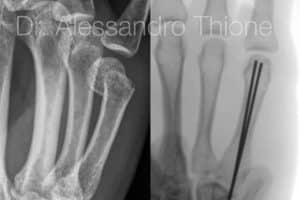Fractura de metacarpiano.