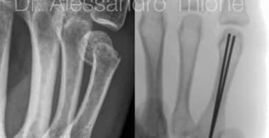 Fractura de metacarpiano.