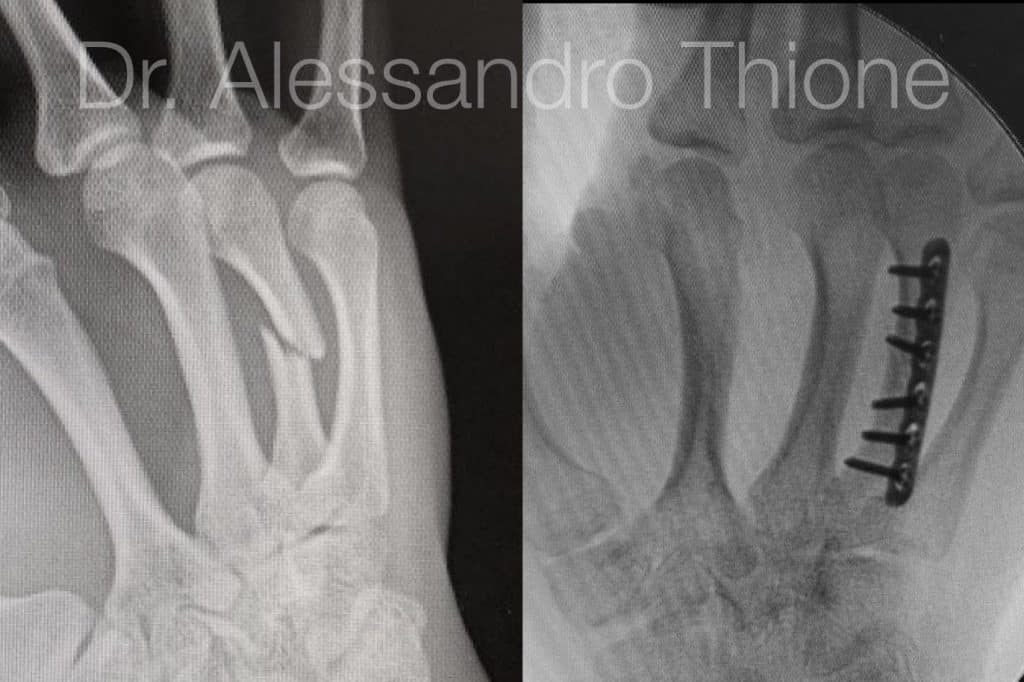 Fractura de metacarpiano
