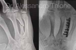 Fractura de metacarpiano