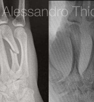 Fractura de metacarpiano