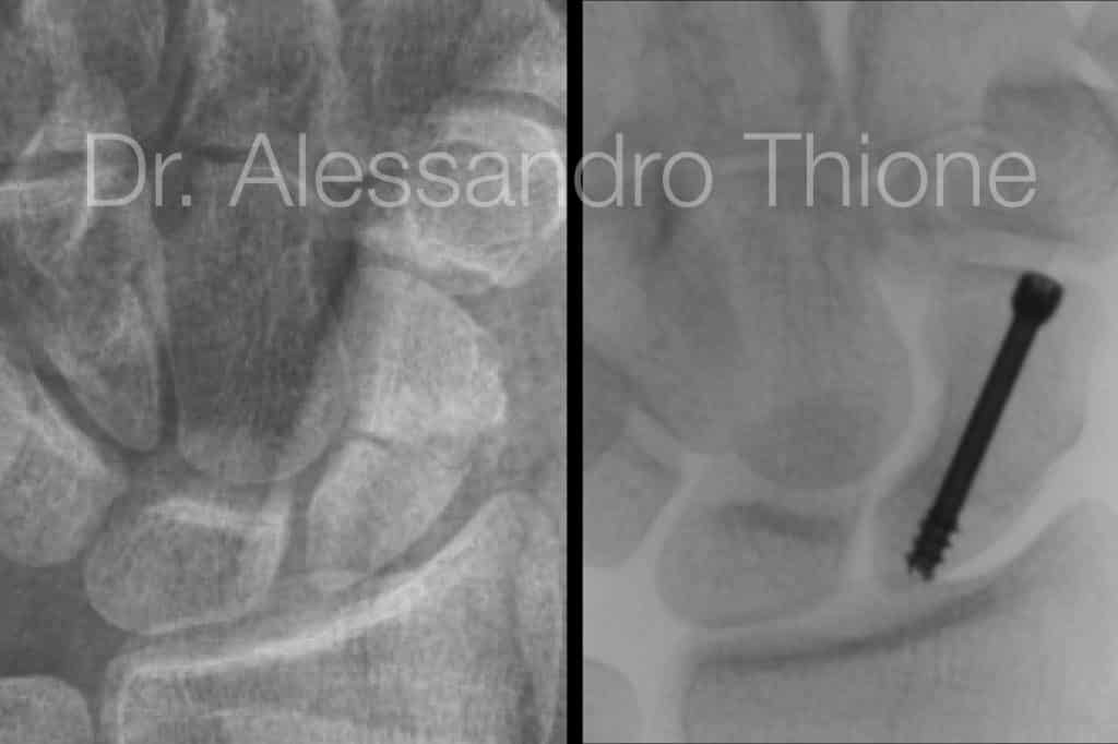 Fractura de escafoides.