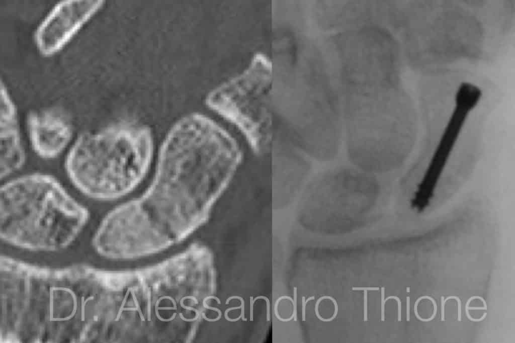 Fractura de escafoides: fractura de tubercolo proximal de escafoides.