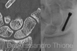 Fractura de escafoides: fractura de tubercolo proximal de escafoides.