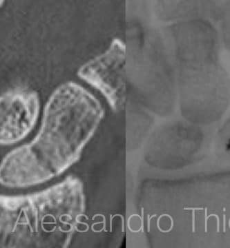 Fractura de escafoides: fractura de tubercolo proximal de escafoides.