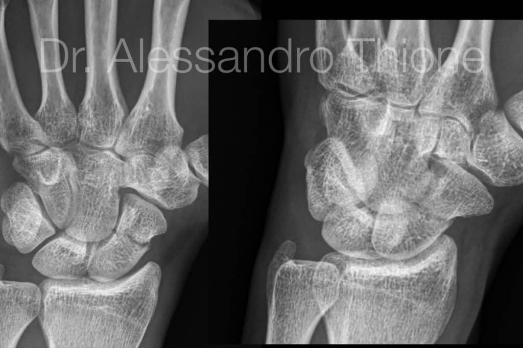 Fractura de escafoides
