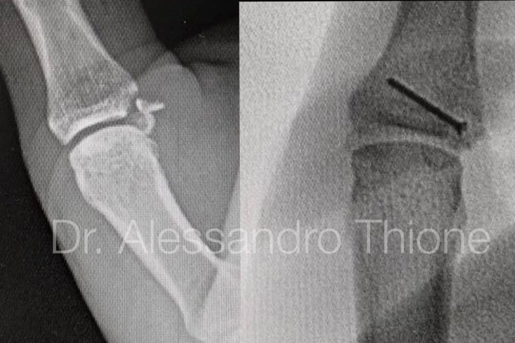 Lesion de Stener y fractura de falange proximal de pulgar