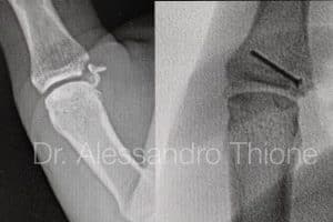 Lesion de Stener y fractura de falange proximal de pulgar
