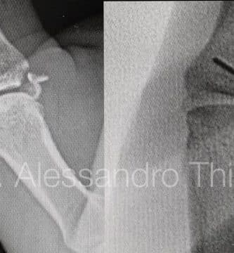 Lesion de Stener y fractura de falange proximal de pulgar