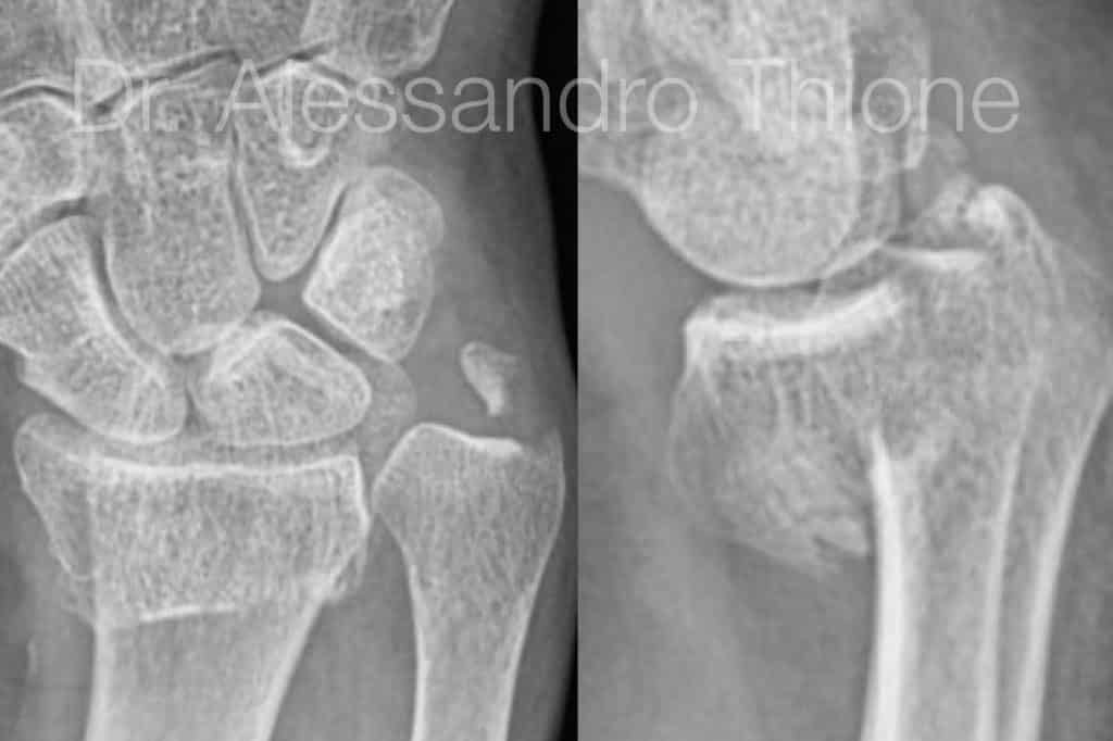 Fractura de radio distal