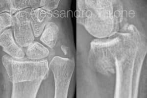 Fractura de radio distal