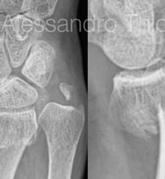 Fractura de radio distal