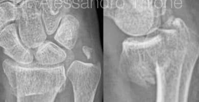 Fractura de radio distal