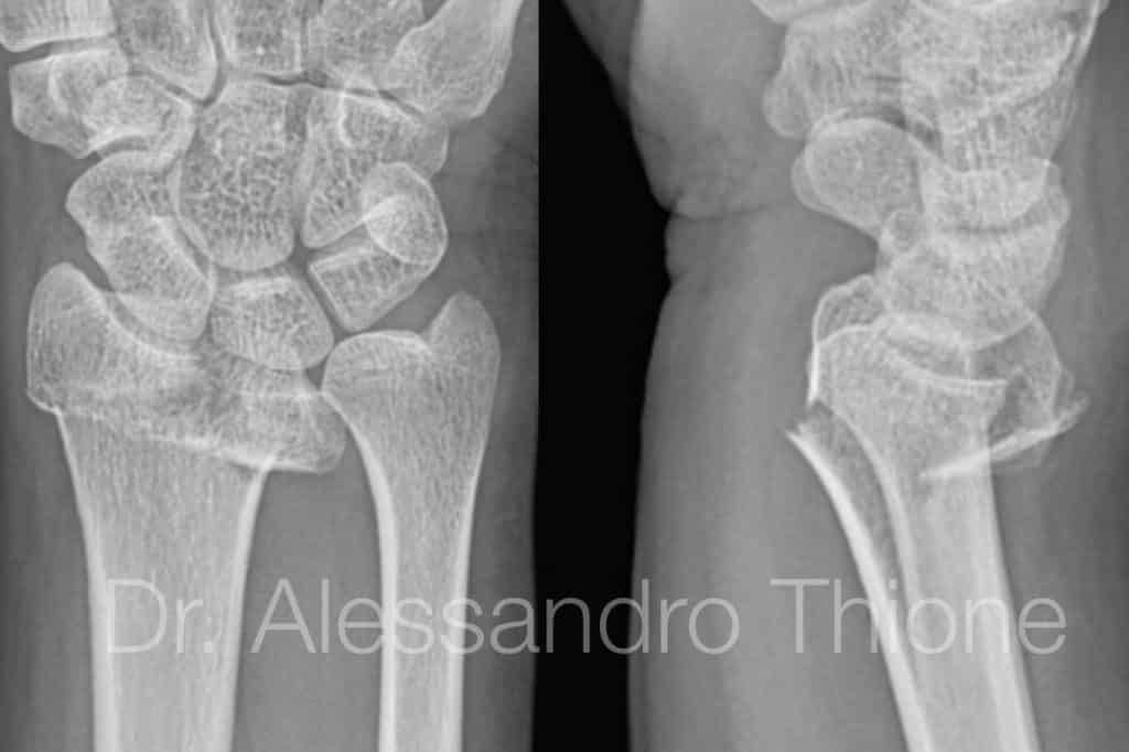 Fractura de muñeca