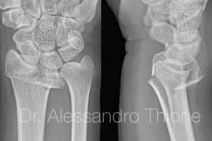 Fractura de muñeca