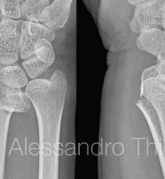 Fractura de muñeca