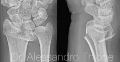 Fractura de muñeca