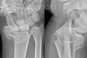 Fractura de muñeca.