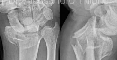 Fractura de muñeca.