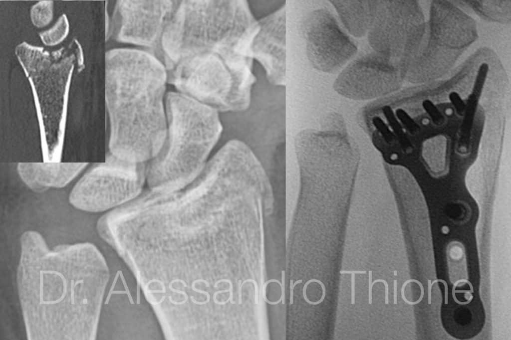 Fractura de muñeca
