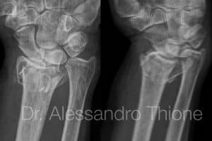 Fractura de muñeca