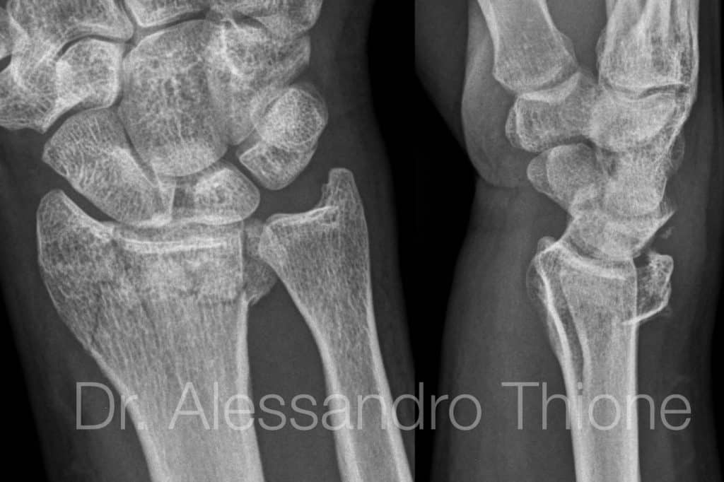 Fractura cerrada intrarticular de radio distal