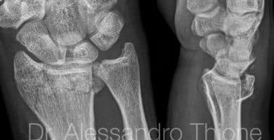 Fractura cerrada intrarticular de radio distal