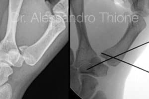 Fractura de Bennett
